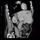 Collision tumour, adrenal adenoma, metastasis: CT - Computed tomography